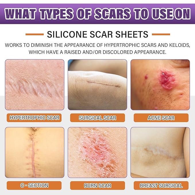 Silicone Scar Removal Strips for Surgical,C-Section,Tummy Tuck,Keloid Scars (1.6"X 59" Roll-1.5M) Keloid Bump Removal